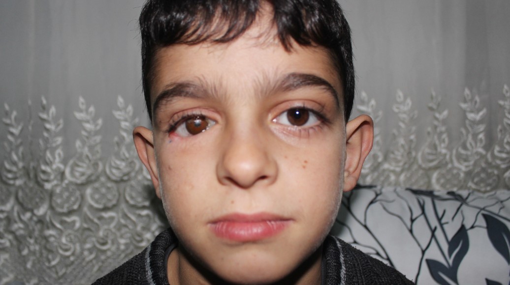 Suriyeli Mahmut protez gözüne kavuştu