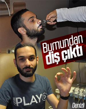 Denizli'de yaşayan öğrenci burnundaki diş ile 6 yıl yaşamış