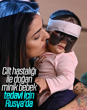 Nadir görülen cilt hastalığı ile doğdu