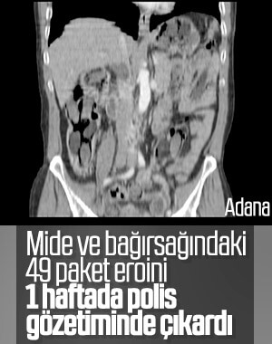 Adana'da midesindeki uyuşturucuları 1 haftada çıkardı