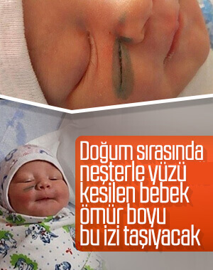 Rusya'da doktorlar doğum sırasında bebeğin yüzünü kesti