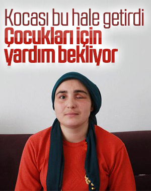 Kocası tarafından darbedilen kadının tek gözü alındı