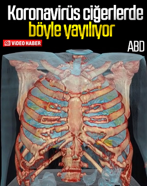 ABD'de korona bulunan akciğerin 3D görüntüsü paylaşıldı
