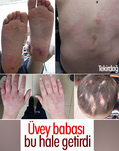 Tekirdağ'da 7 yaşındaki çocuğu üvey babası darbetti