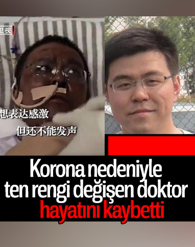 Ten rengi değişen Çinli doktor hayatını kaybetti