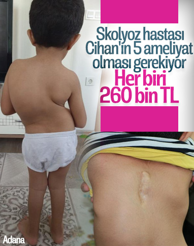 Adana'da skolyoz hastası Cihan'ın ailesi yardım bekliyor