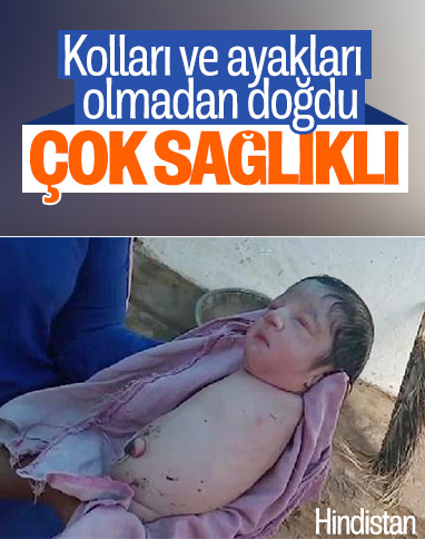 Hindistan’da kolları ve bacakları olmadan doğan bebek
