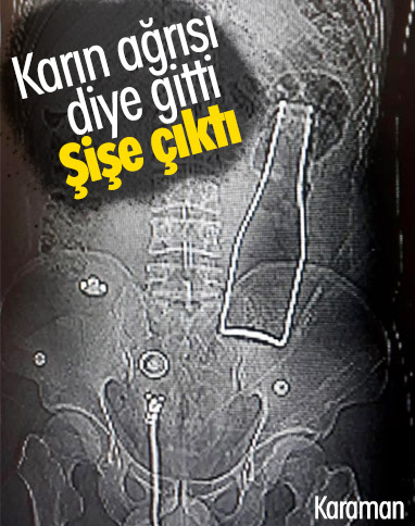 Karaman'da karın ağrısıyla hastaneye gitti, şişe çıktı