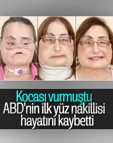 ABD’de ilk yüz nakilli Connie Culp, hayatını kaybetti