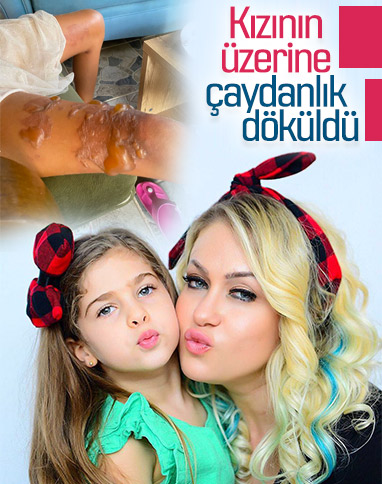 Yeliz Yeşilmen'in kızı kaynar suyla yandı