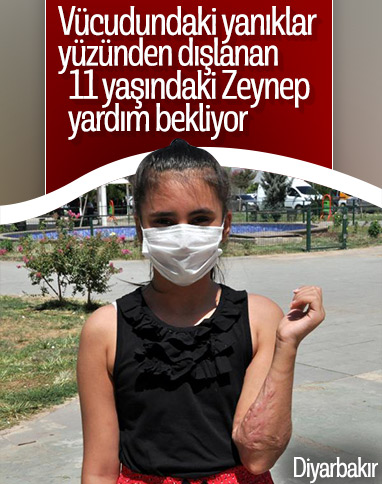 Diyarbakır'da üzerine kazan devrilen Zeynep yardım bekliyor