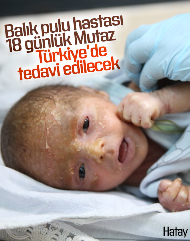 Balık pulu hastası 18 günlük Mutaz, Türkiye'ye getirildi
