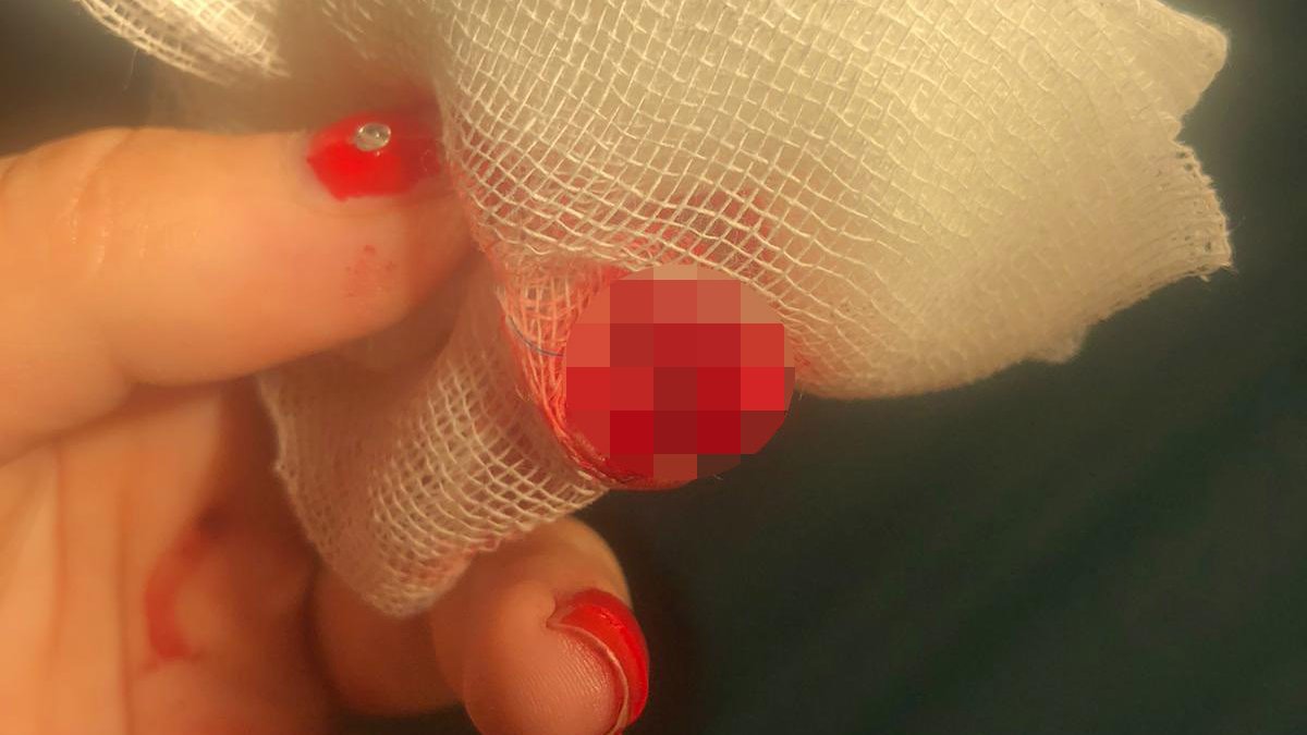 Sinop'ta sandalyeye eli sıkışan kadının parmağı koptu