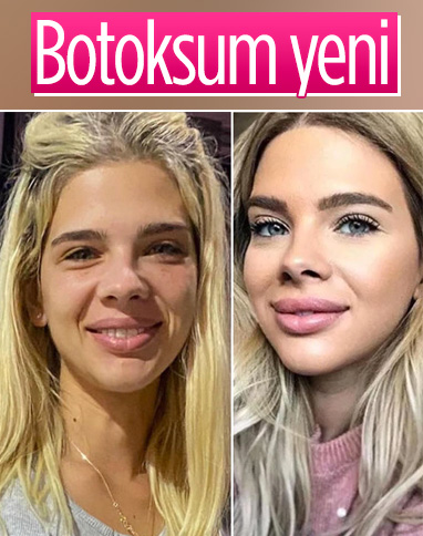 Damla Ersubaşı: Yüzüme botoks yaptırdım