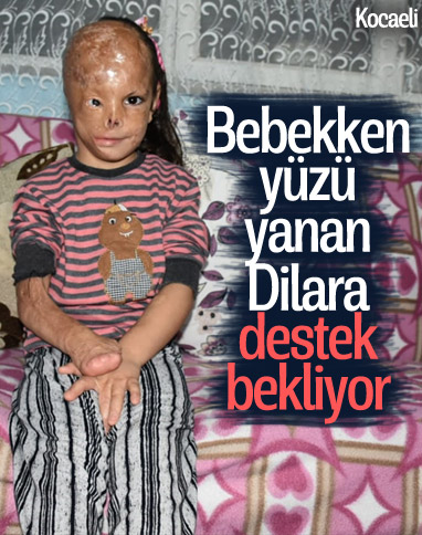 Kocaeli'de bebekken yüzü yanan Dilara yardım bekliyor