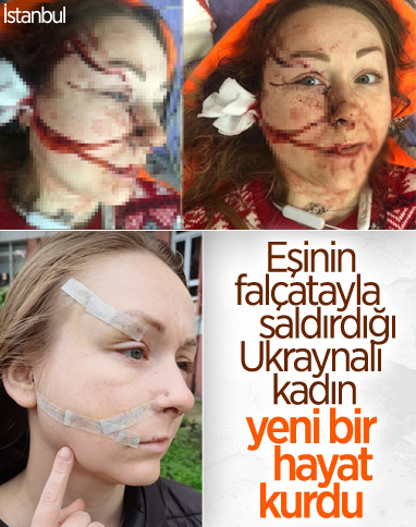 İstanbul’da eşinin falçatalı saldırısına uğradı: Yaşamak istiyorum