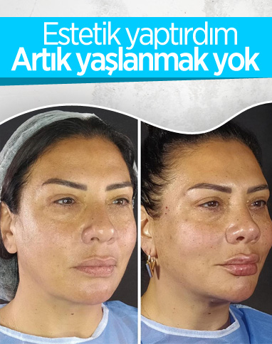 Işın Karaca'dan estetik öncesi ve sonrası paylaşımı