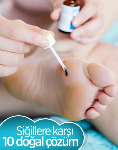 Siğilleri yok etmek için 10 doğal çözüm