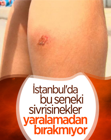 Avcılar’da sivrisinek ısırıkları ile çocuklarda oluşan yaralar paniğe neden oldu