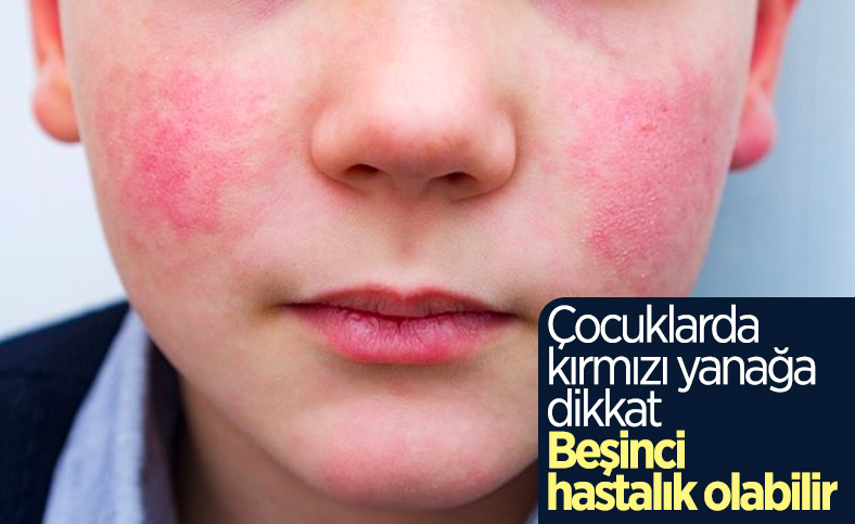 Çocuklarda kırmızı yanak beşinci hastalık belirtisi olabilir