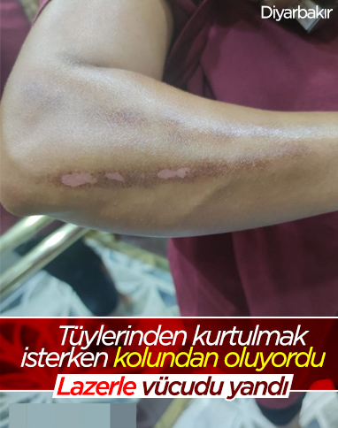 Diyarbakır'daki kadının, lazer yaptırırken kolu ve bacağı yandı