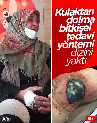 Ağrı’da kulaktan dolma tedaviyi uygulayan kadının dizi yandı