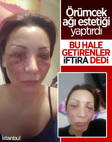 İstanbul’da örümcek estetiği iddiasına savunma