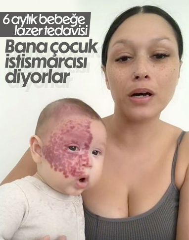 6 aylık bebeğe tepki çeken lazer tedavisi