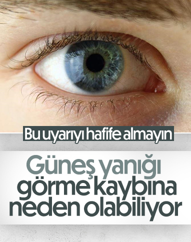 Gözde oluşan güneş yanığı görme kaybına yol açıyor