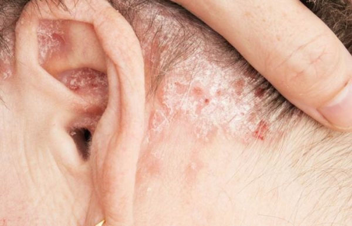 Seboreik dermatit nedir? Seboreik dermatit belirtileri nelerdir, nasıl tedavi edilir?