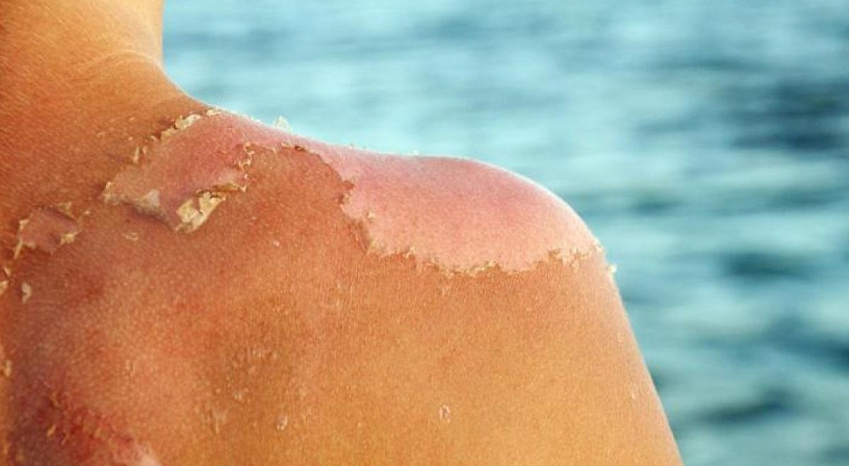 Bikini ve mayo izlerine kolayca veda edin