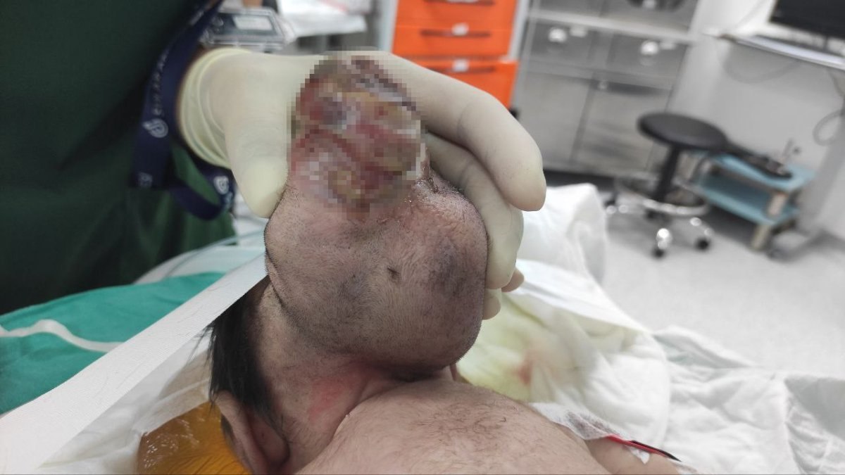 Kahramanmaraş’taki bebek beyninin yarısı kafatası dışında dünyaya geldi
