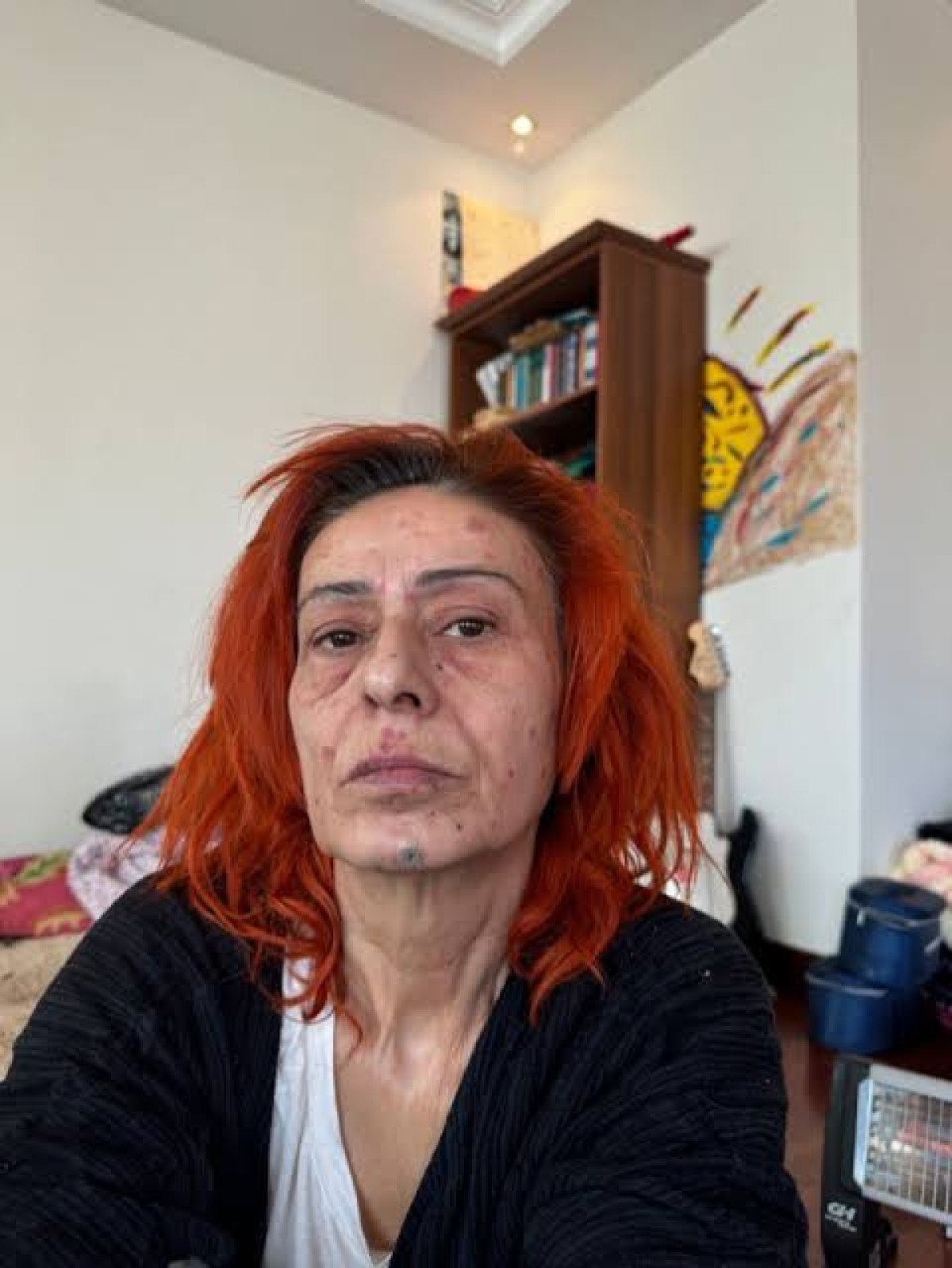 Sevilen Sanatçı Yıldız Tilbe'nin Saç Boyası Nedeniyle Yaşadığı Sağlık Sorunu ve Güncel Durumu