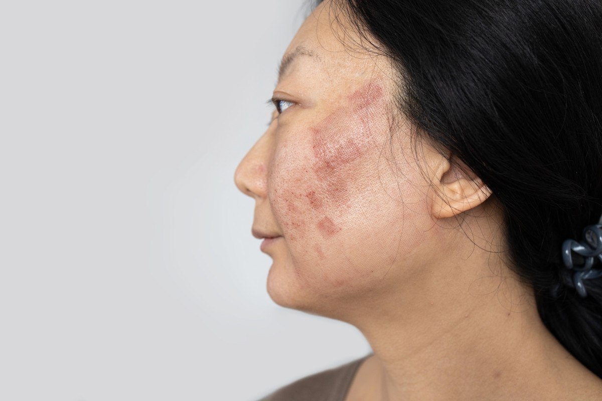 Lupus Hastalığının Bağışıklık Sistemine Etkisi ve Çoklu Organ Tutulumu