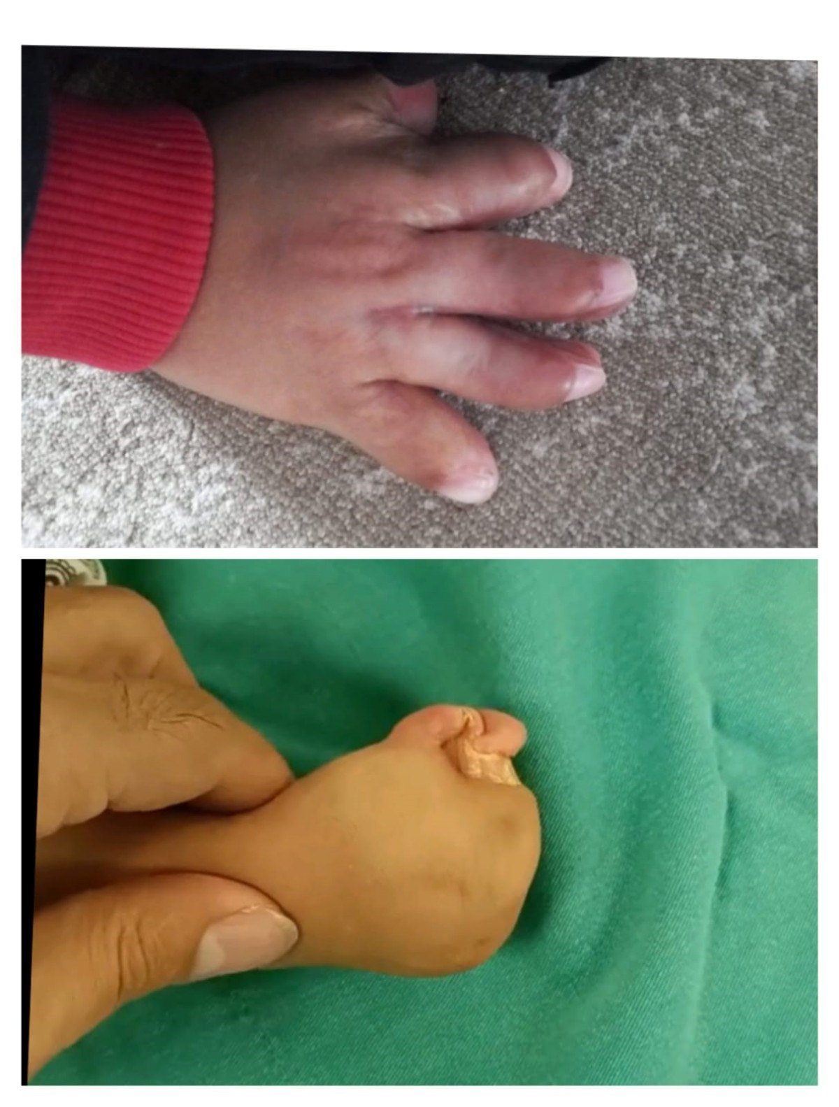 İzmir’de yaşayan 45 yaşındaki Nuriye ve Adem Şahin çiftinin küçük oğlu Umut Aras, doğuştan gelen nadir bir hastalık olan Apert sendromu nedeniyle hayatında büyük zorluklar yaşıyordu. 4 yaşındaki çocuklarının ellerindeki parmakların yapışık olması, günlük yaşamını önemli ölçüde zorlaştırıyordu. Ailesi, oğullarına en iyi tedavi imkanlarını sağlamak adına birçok hastane ve uzmanla iletişime geçti, fakat doğru tanı ve uygun tedaviye ulaşmakta ciddi güçlükler yaşadı.