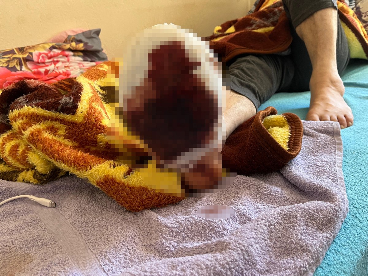 Uzun Süredir Şeker Hastalığıyla Mücadele Ediyordu