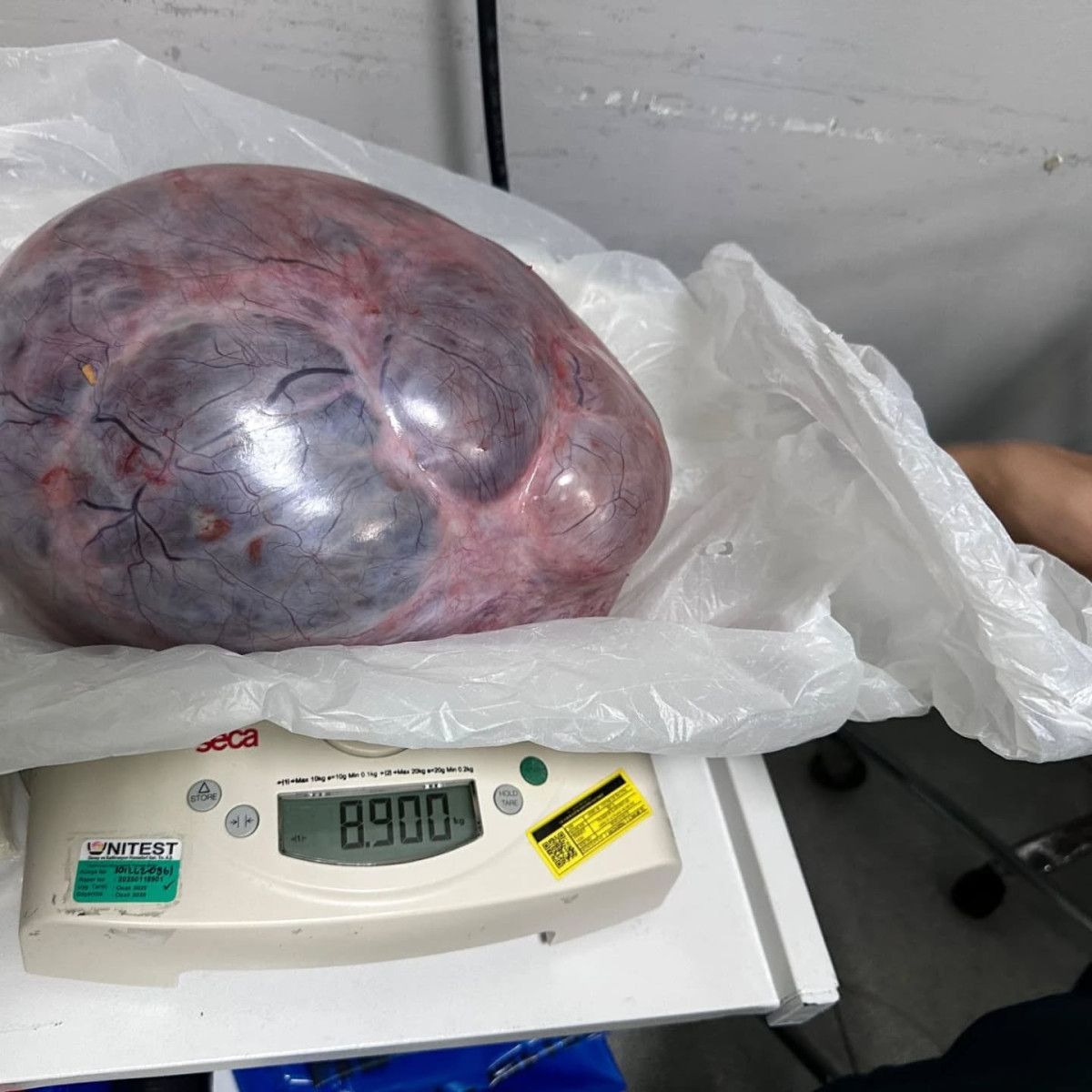 Trabzon'da yumurtalıklarından 9 kiloluk kitle çıktı