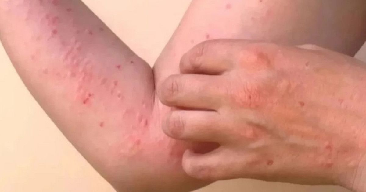 DSÖ'nün uyardığı Chikungunya virüsü tehlikeli değil