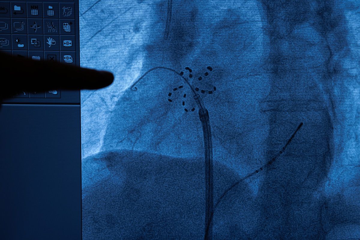 Pulsed Field Ablation ile AF Tedavisinde Yeni Bir Dönem: Güvenli ve Etkili Bir Yaklaşım