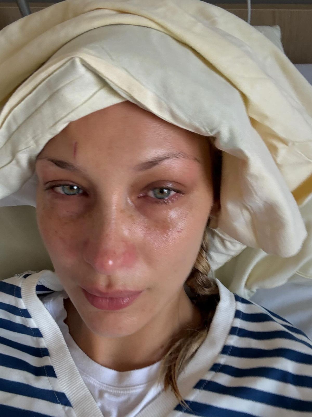 Lyme Hastalığıyla Mücadelede Bella Hadid: Tedavi Süreci ve Sessiz Duruş