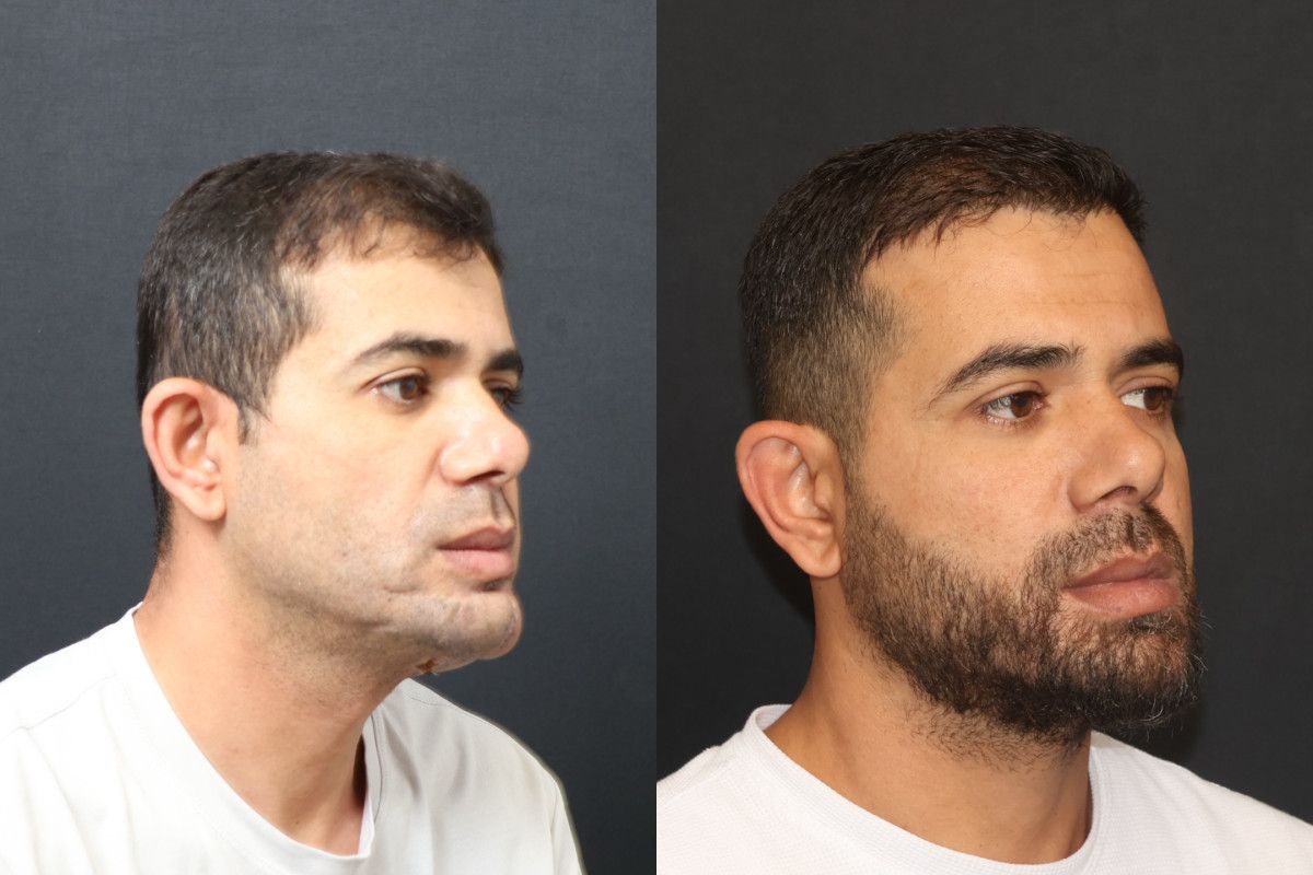 İzzet Baldır’ın Çene Yarasıyla Süzülen Yol: Mikrocerrahiyle Yeniden Yaşama Dönüş