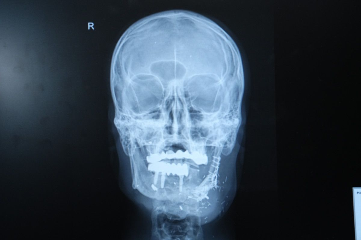 İzzet Baldır’ın Çene Yarasıyla Süzülen Yol: Mikrocerrahiyle Yeniden Yaşama Dönüş