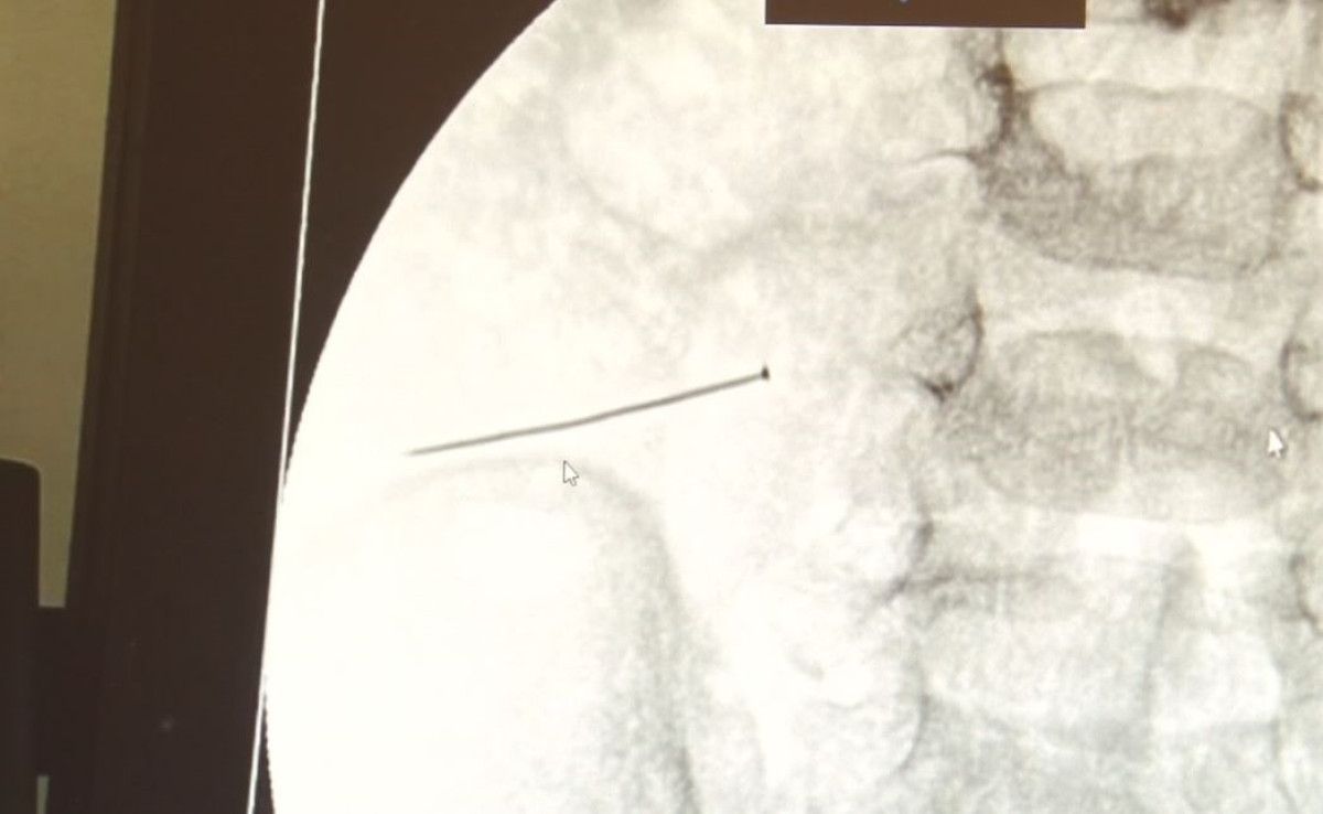 İğneyle Gelen Tehlike: 2 Yaşındaki Çocukta İnce Bağırsak Delinmesi ve Acil Ameliyat