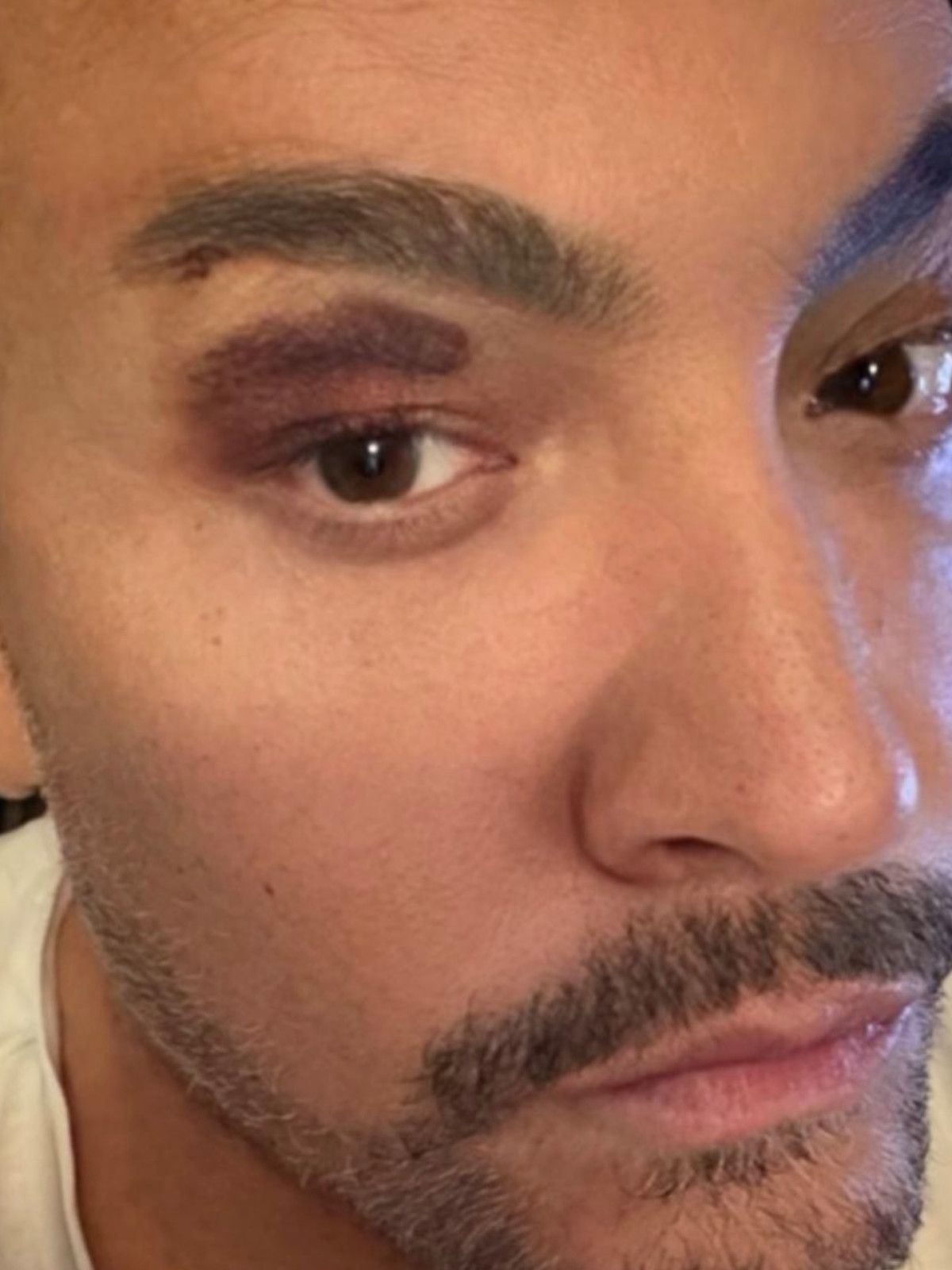 Kendisiyle İlgili Ultrakısa Bir Anı: Kaşını Patlatan Şarkıcıdan Yeni Şarkı Müjdesi