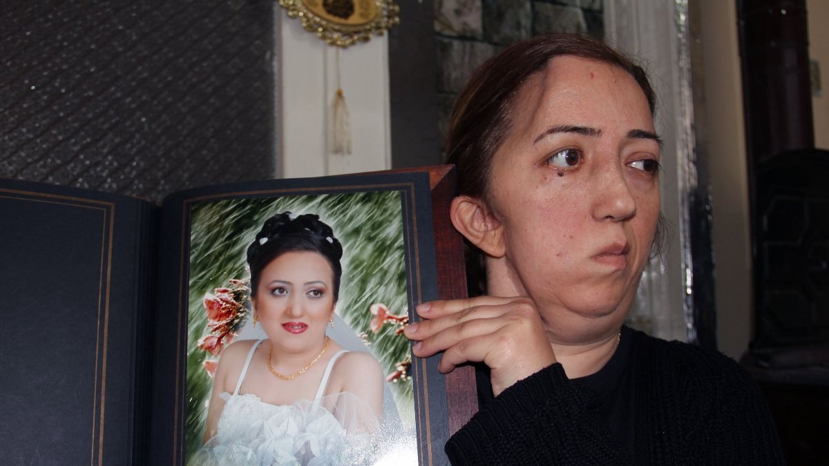 Giresunlu hemşire ameliyat sonrası felç geçirdi, kafatası kayboldu