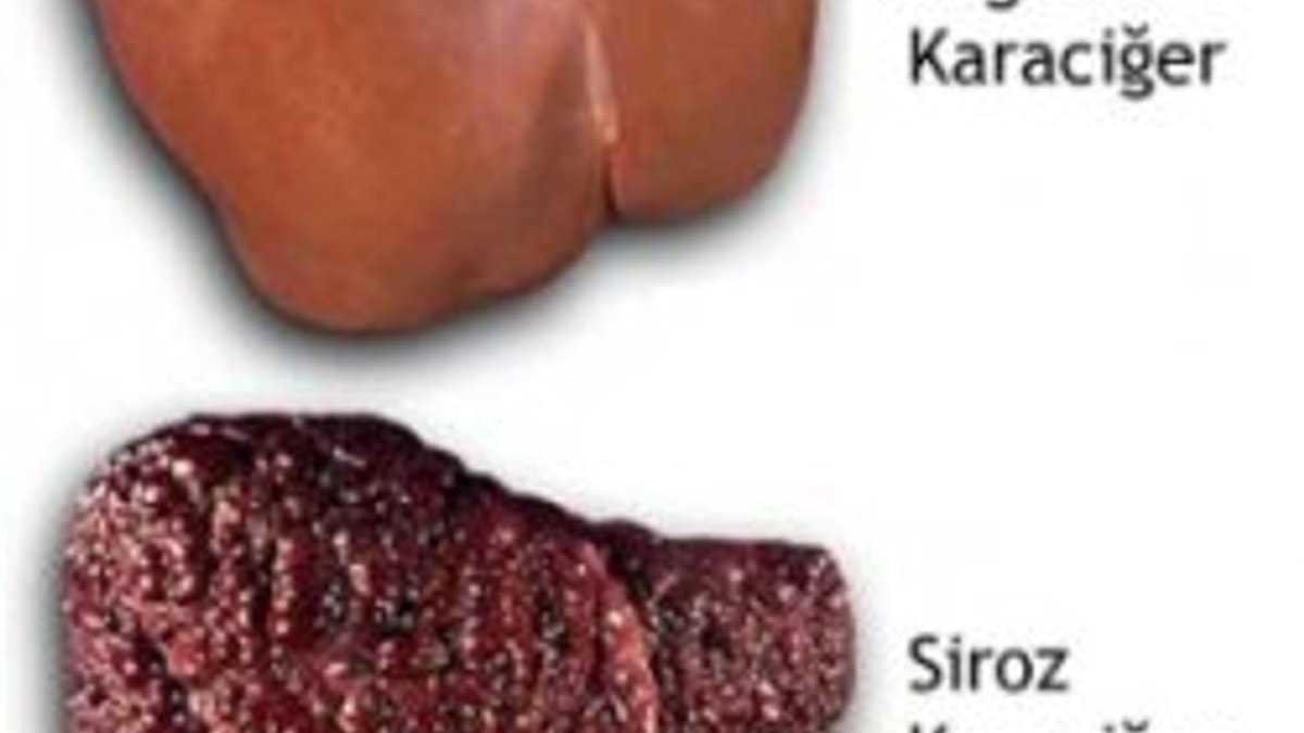 Siroz Nedir?