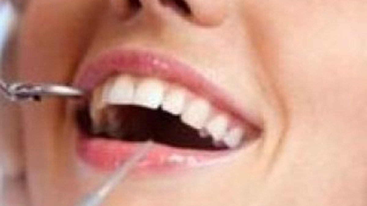 Dişler için görünmeyen tel dönemi