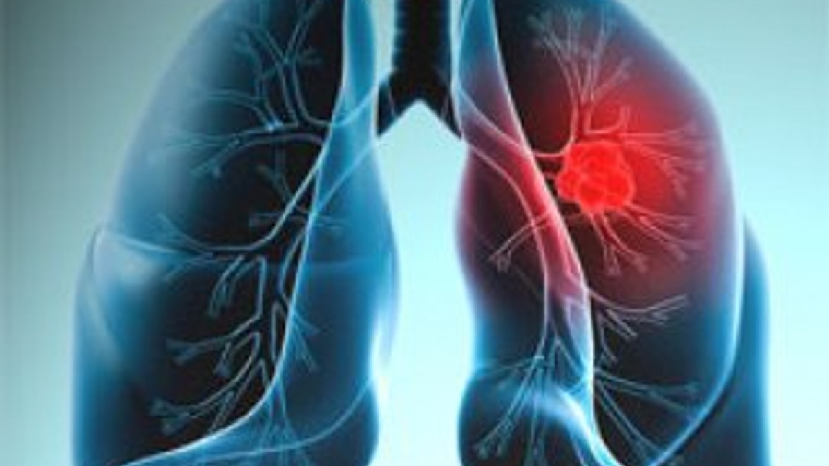 Nefesten akciğer kanseri teşhisi yakın