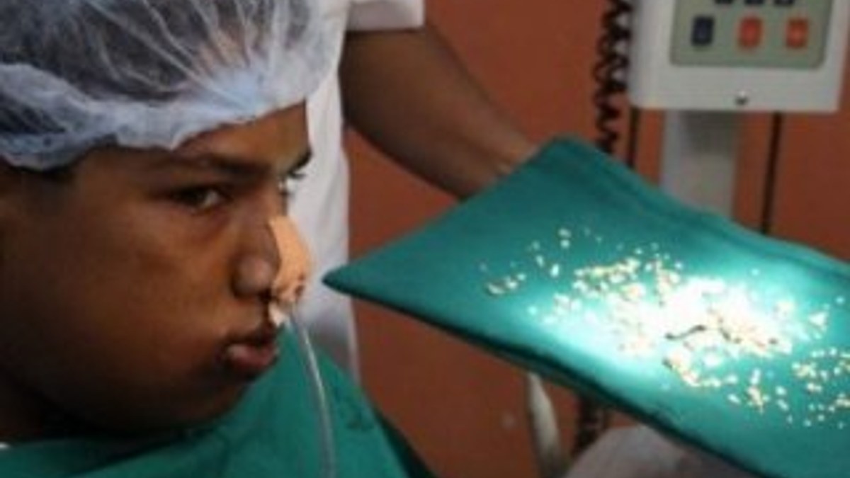 Hindistan'da bir gencin ağzından 232 adet diş çıkarıldı