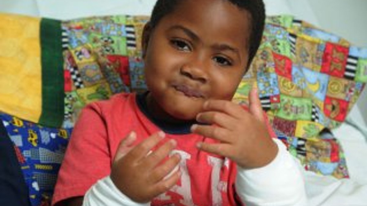 Dünyada ilk defa bir çocuğa el nakli yapıldı